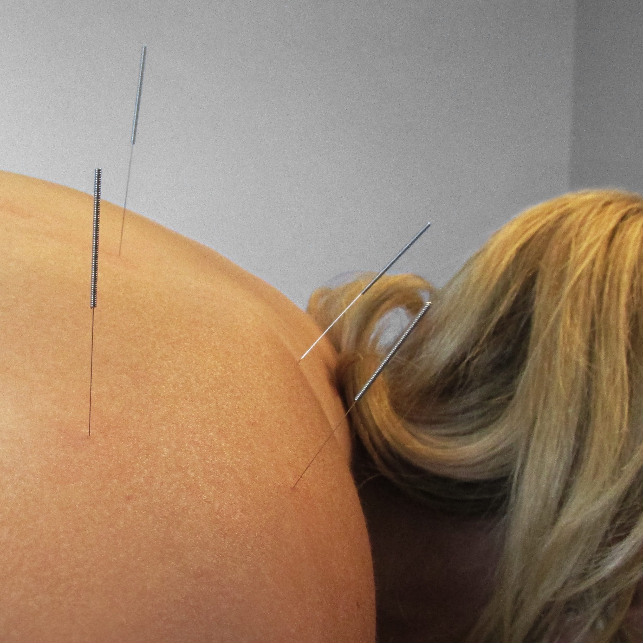 acupuncture back pain